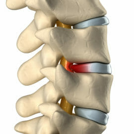 Bulging-disc-comparison-e1593804166597.jpg